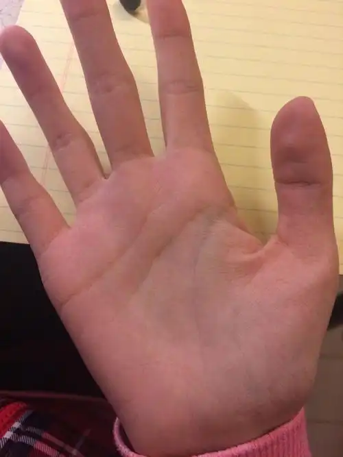 生命线有岛纹 只有这一个手 我才15啊 我这个算岛纹么 怎么办.