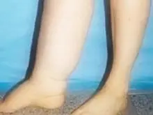 子宫癌术后,鉴定为右肢淋巴水肿,现在出