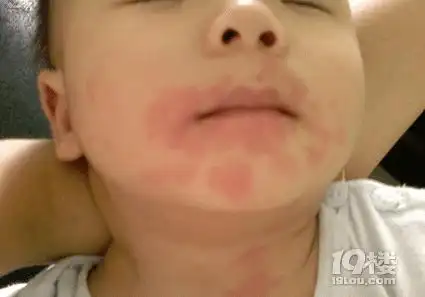 蛋白质过敏怎么办 新手妈妈必看科普贴