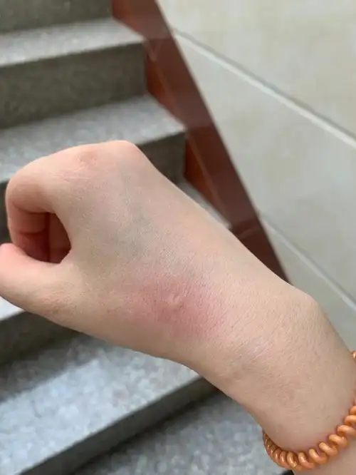 蚊子03块都变成了爱你的形状0606