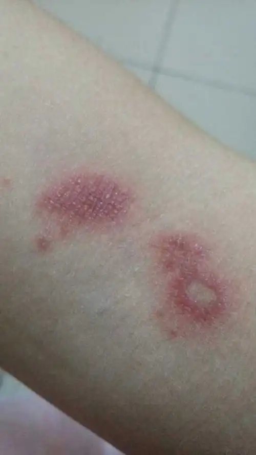 预防宝宝被虫咬皮炎图片