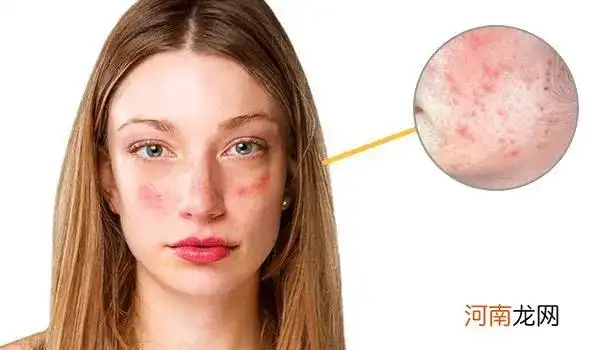 文章插图如果你也曾经出现以上情况,很大可能你的皮肤屏障已经受损了