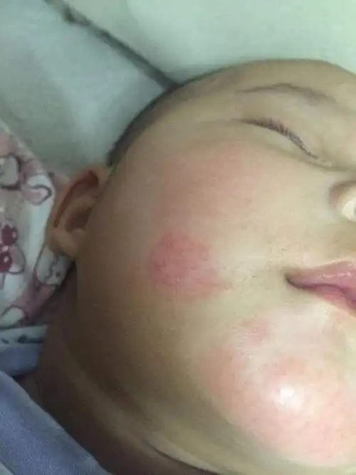 有的宝宝还会有红血丝,一热就是一天,外人看着