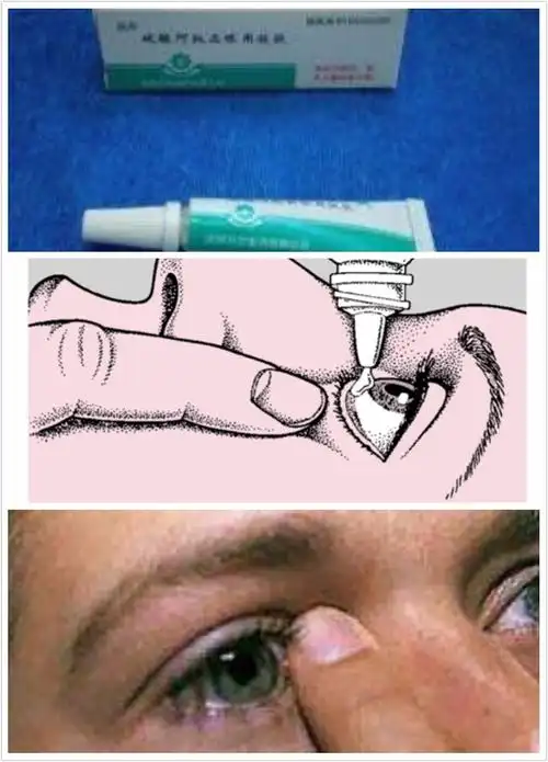 1阿托品眼膏散瞳注意事项