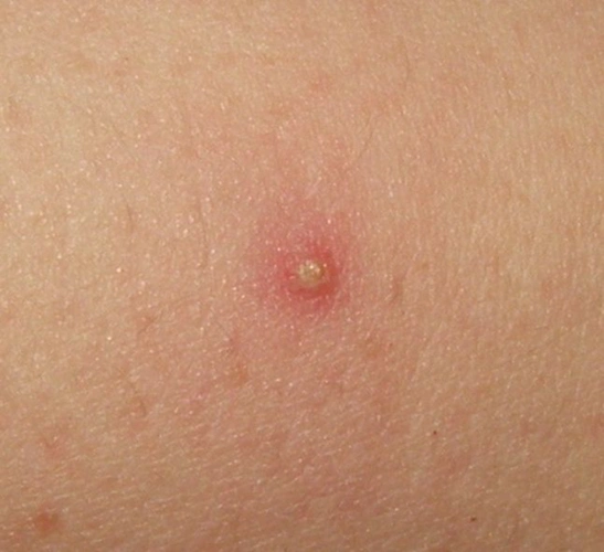 皮肤上长这个"包"请一定要注意!