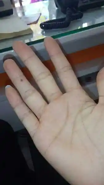 女孩子右手无名指突然长出一棵深褐色的痣,有刺痛的感觉,这是为什么?