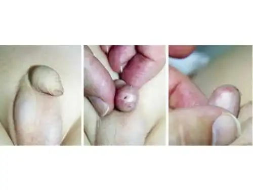 【小児外科】小児外科で多い病気 停留精巣包茎