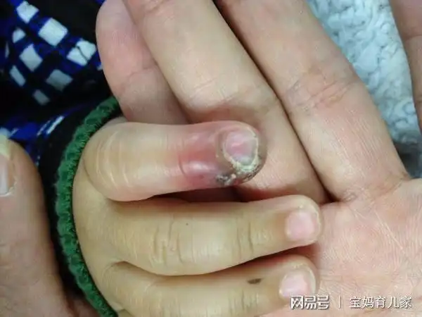 孩子总爱撕咬指甲甲沟炎肚子痛烂牙齿这些后果你知道吗