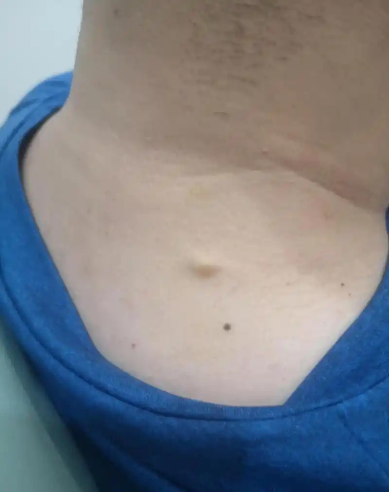 皮下脂肪瘤 火针完全可以破坏包膜 做个两三次就好 还不复发 何必冒着