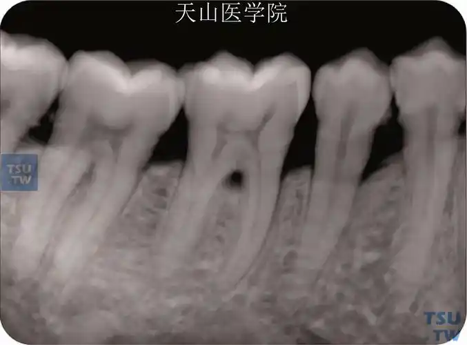 下颌第一磨牙指向颊侧的沟状根尖,x线片上不明显