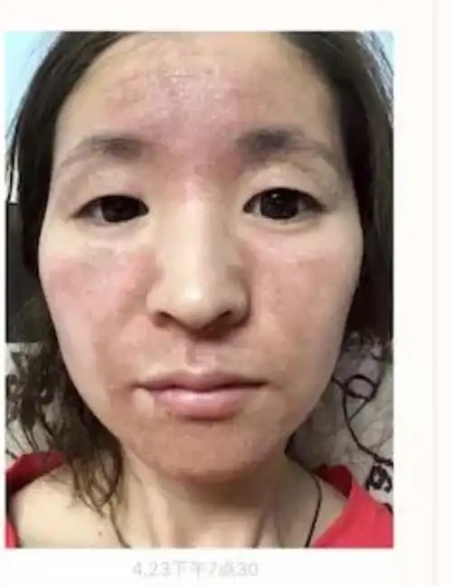 面部湿疹治疗全过程
