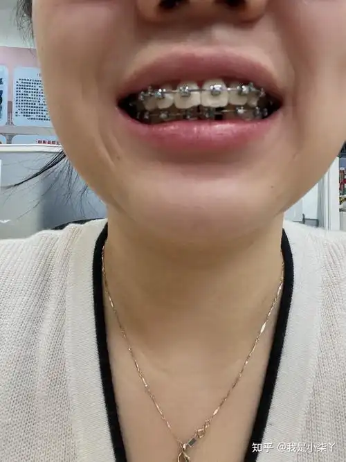 28岁小龅牙的整牙之旅 - 知乎