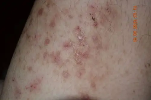 大腿上长出的这些是什么皮肤病?有图,刚长出来时痒,有色素.