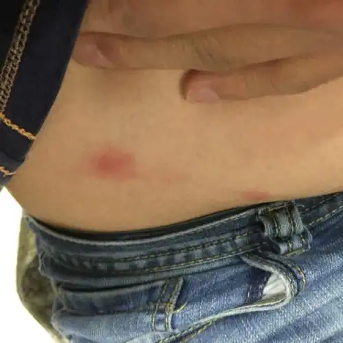 问:我想问一下这是不是疥疮?