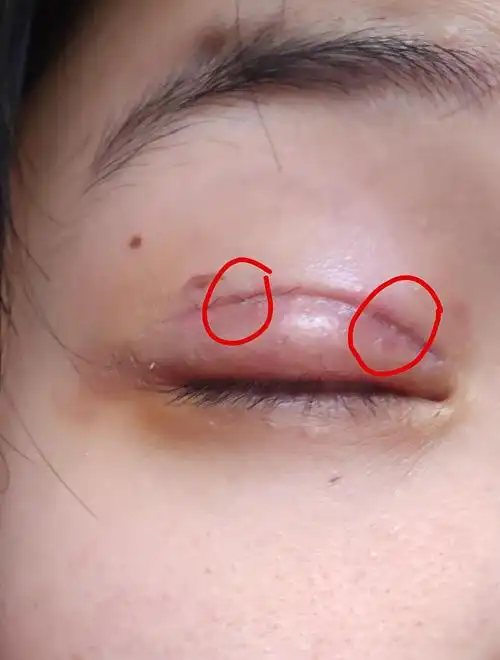 更新今天起床之后就好了应该是线结反应明天要去拆线啦