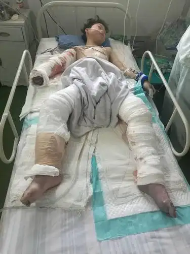 迁安扣庄13岁男孩面临双腿,右臂截肢手术 需要大家帮助