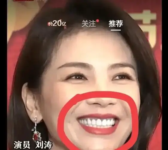 2022春晚刘涛黑色牙龈上热搜,网友称不敢再做烤瓷牙了_牙齿_假牙_后遗