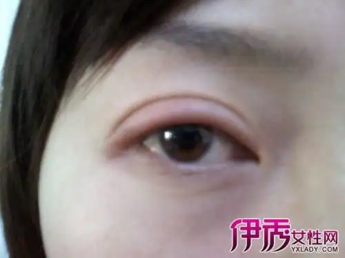 【图】上眼睑肿是什么原因 四大方法轻松消除眼睑浮肿