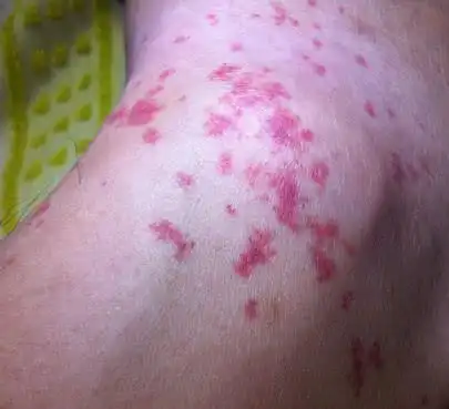 一旦脚上有这3迹象八成肝脏已病不轻别等肝癌找上门