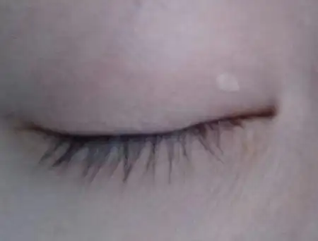 右眼皮上长了一个白色的小肉疙瘩,不痛不痒,怎么办?