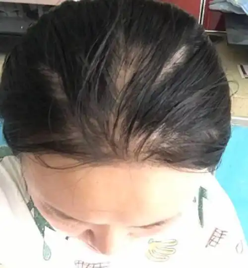 产后脱发严重怎么办(女士产后脱发严重怎么办)