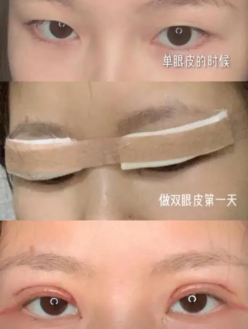 还在担心双眼皮疤痕吗这款祛疤膏真的太顶了