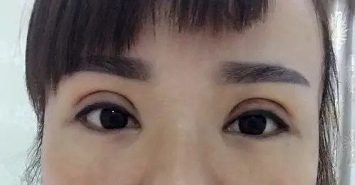 双眼皮做的全切第十一天了,太宽太深了,能修复吗?