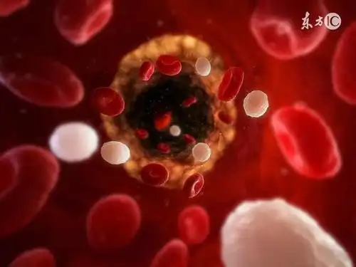 5个征兆一出现说明血管堵的很严重4种血管清道夫便宜又好用