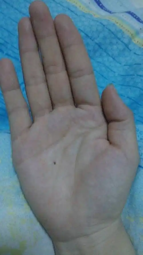 右手手掌心有痣,求解