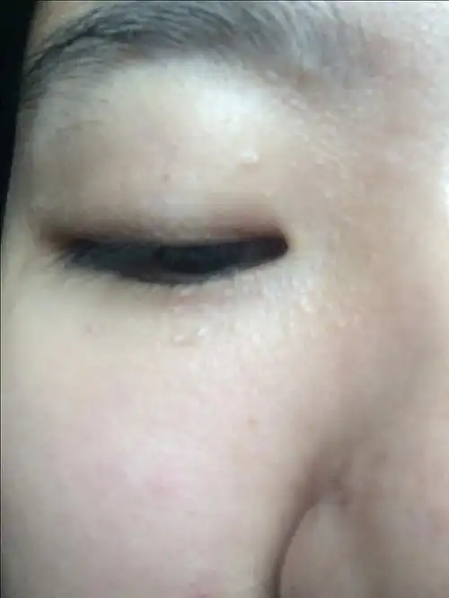 脸上有很多脂肪粒怎么办!