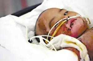 两岁儿童跌进开水锅被严重烫伤图