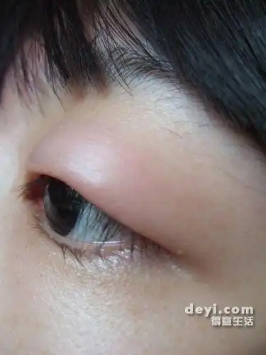 急!眼睛肿成这个像么办!