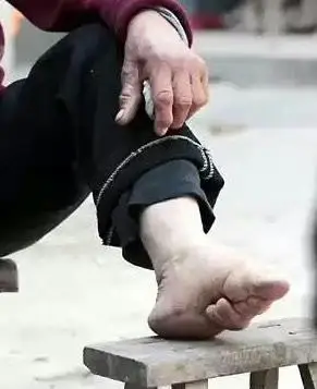 小脚近照(资料片)