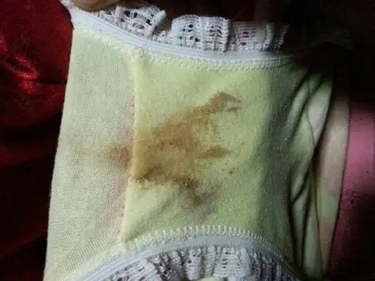 血性白带图片36