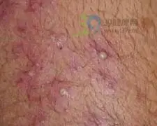 网状红斑萎缩性毛囊炎