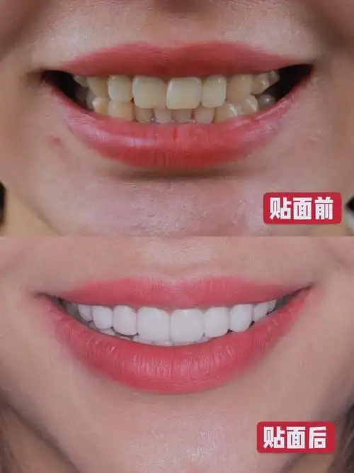 ●分享顾客宝宝的贴面案例, 来自宝宝个人_春天去哪玩_美牙仪_牙齿贴