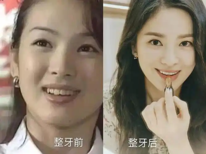 而娱乐圈也有很多明星做过矫正,如高圆圆.