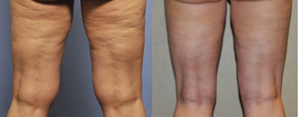 而且一次吸脂的量也都是有限制的,这样不会导致皮肤松弛的太多,皮肤也