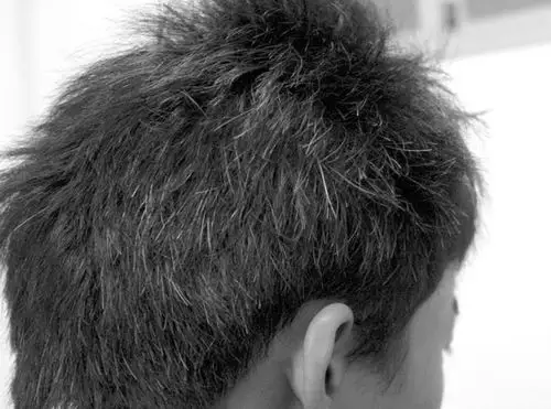 男人中年长白发怎么办?