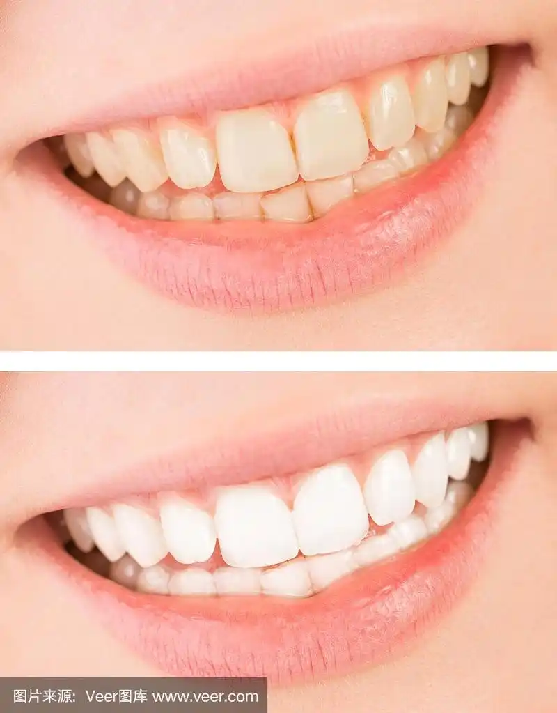 美白-前后微笑及牙齿美白治疗.
