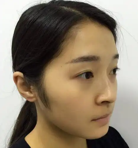 看看我的术前丑照吧,我的鼻子山根很低,而且鼻梁露骨我返日记的时候