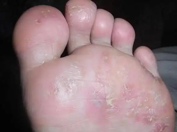 为什么脚上会长水泡原因竟然是这个