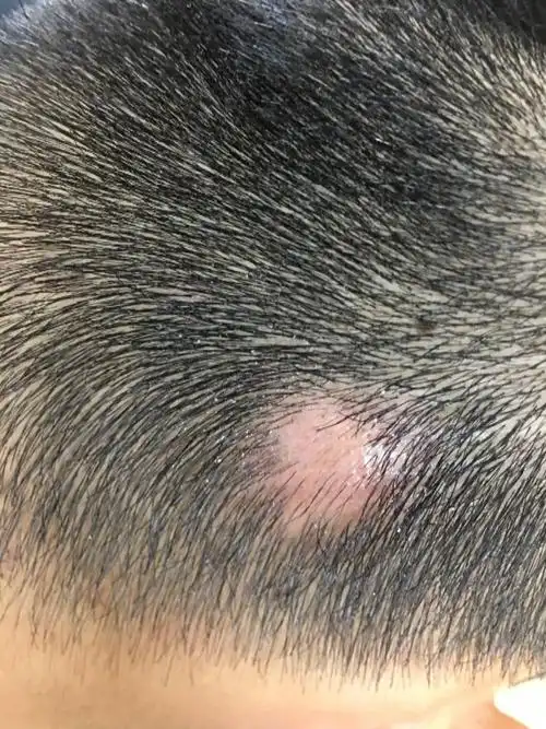 后脑勺有个肿块,按压的话会有点疼,头发也没了.买了一盒治毛囊炎的