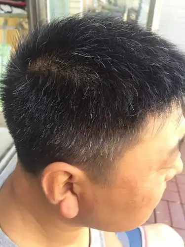 后天性白发有老年性白发和少年白发两种.有的年迈体弱而白发很少.