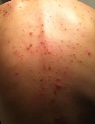 别告诉我是毛囊炎!