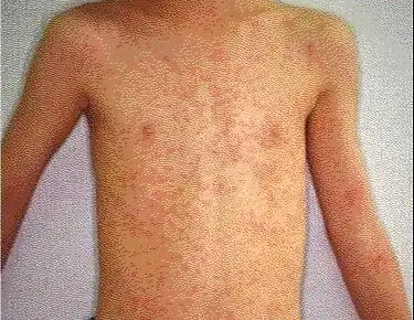 伴有发热的皮肤病(二):发疹发热性传染病