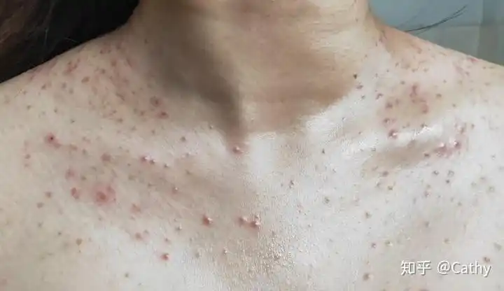 马拉色菌毛囊炎怎么治