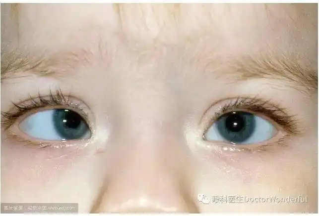 性斜视患儿,其由于大脑皮质主动抑制斜眼的视觉冲动,长期抑制形成弱视