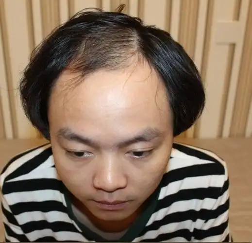 脱发形象使他在相亲路上越走越远,最终下定决定去做植发来改善.