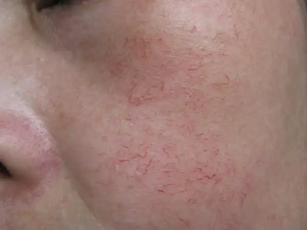 治疗红血丝的较佳方法是什么